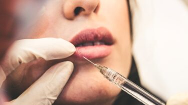 Fillers i læberne